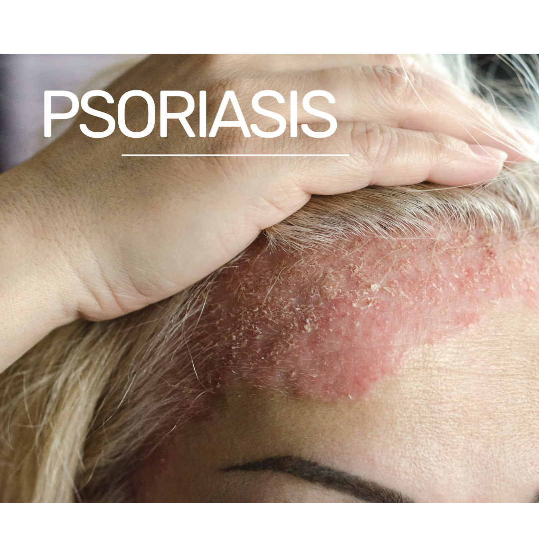 How does psoriasis start?