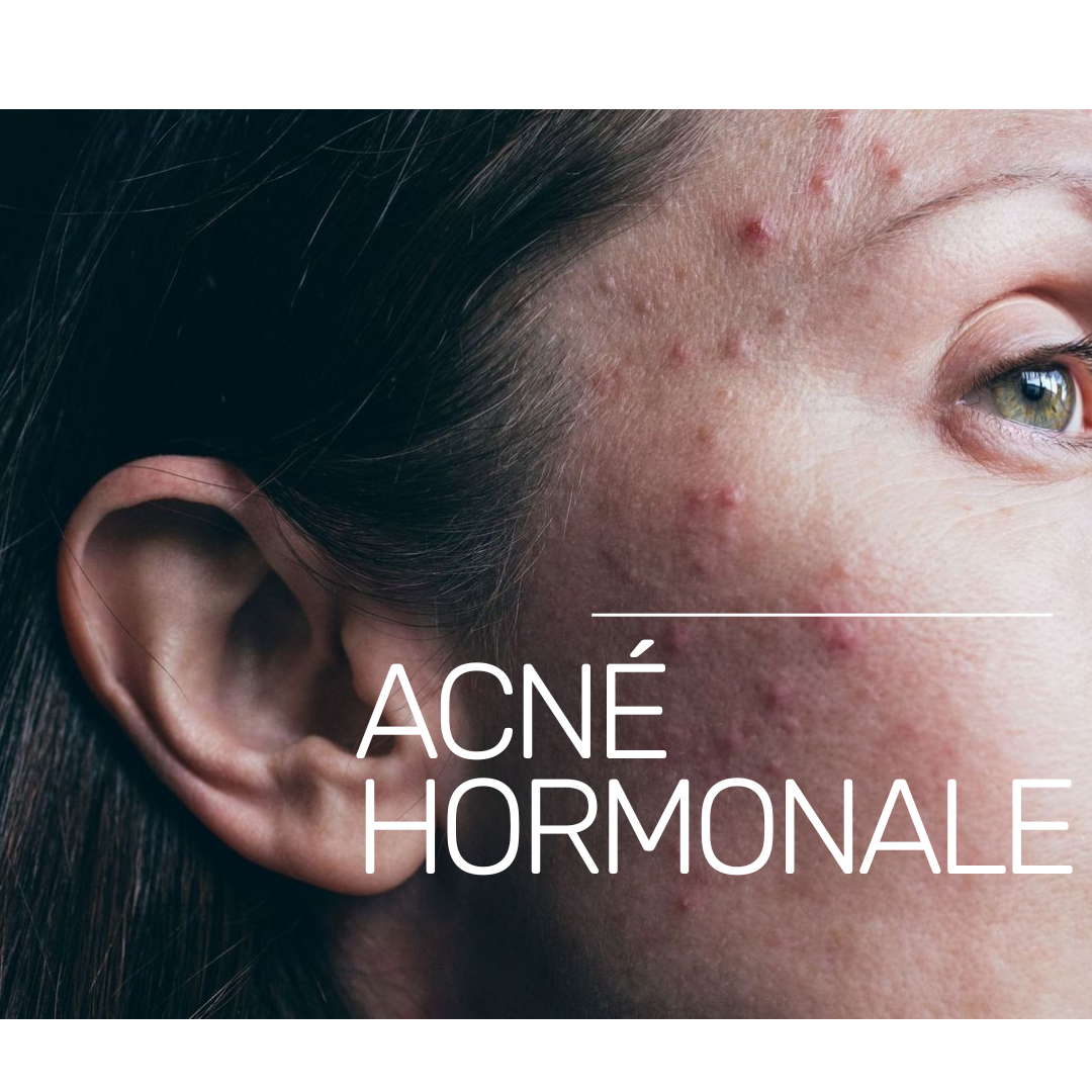What are the 3 main factors in hormonal acne?