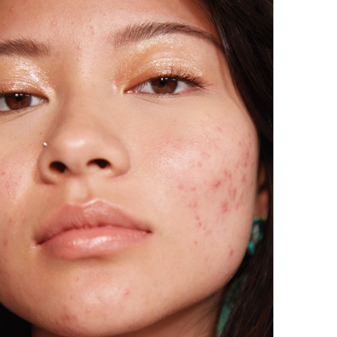 How to get rid of acne on the face?